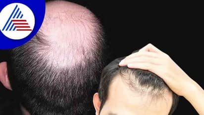 Hair Health : ಕೂದಲು ಉದುರಲು ಅತಿಯಾದ ಹಸ್ತಮೈಥುನವೂ ಒಂದು ಕಾರಣ