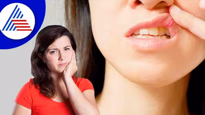 Mouth Ulcers:  வாய் புண் இருக்கா? வீட்டில் இருந்து சரி செய்ய இந்த டிப்ஸ் ட்ரை பண்ணுங்க..!!