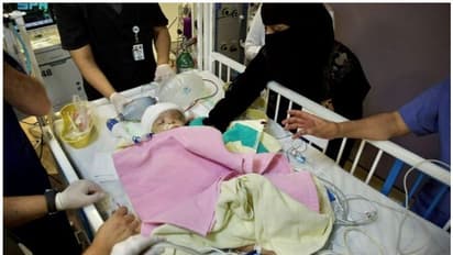 15 മണിക്കൂര്‍ നീണ്ട ശസ്ത്രക്രിയ വിജയം; സയാമീസ് ഇരട്ടകളായ യൂസുഫിനും യാസീനും ഇനി വേറിട്ട ജീവിതങ്ങള്‍