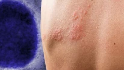 Monkeypox Virus : മങ്കിപോക്സും സെക്സും തമ്മില്‍ എന്ത് ബന്ധം?