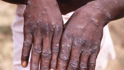 Monkeypox : കുരങ്ങുപനി ; രോഗികളുടെ എണ്ണം ഇനിയും വർദ്ധിച്ചേക്കാമെന്ന് ലോകാരോ​ഗ്യ സംഘടന