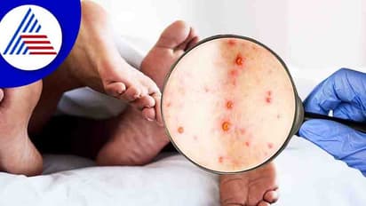 Monkeypox Virus : ശുക്ലത്തില്‍ മങ്കിപോക്സ് വൈറസ് സാന്നിധ്യം; ലൈംഗികരോഗമാണെന്ന വാദം കനക്കുന്നു...
