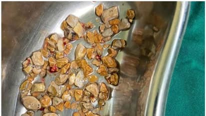 കഠിനമായ വയറുവേദന; 56കാരന്‍റെ വൃക്കയിൽ നിന്ന് നീക്കം ചെയ്‌തത് 206 കല്ലുകൾ