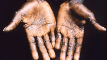 Antiviral medications likely to reduce symptoms of Monkeypox, suggests Lancet study