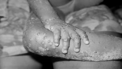 Monkeypox :  ആന്റിവെെറൽ മരുന്നുകൾ  കുരങ്ങുപനിയുടെ ലക്ഷണങ്ങൾ കുറയ്ക്കും; ലാൻസെറ്റ് പഠനം