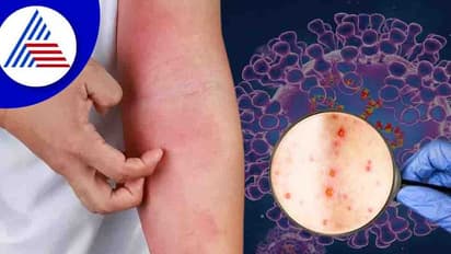 ಜಗತ್ತಿನಾದ್ಯಂತ ಮಂಕಿಪಾಕ್ಸ್ ಭೀತಿ, ಬೆಲ್ಜಿಯಂನಲ್ಲಿ 21 ದಿನ ಕ್ವಾರಂಟೈನ್ ಕಡ್ಡಾಯ