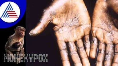 Monkeypox: పిల్లల్లో కనిపించే మంకీపాక్స్ లక్షణాలు ఇవే.. నిర్లక్ష్యం చేయకండి..