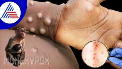 ಕೇರಳದಲ್ಲಿ ಮೊದಲ ಶಂಕಿತ Monkeypox ಪ್ರಕರಣ ಮತ್ತೆ