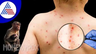 ಮಕ್ಕಳಿಗೆ ಮಂಕಿಪಾಕ್ಸ್‌ ಸೋಂಕು ಹರಡದಂತೆ ಎಚ್ಚರಿಕೆ ವಹಿಸುವುದು ಹೇಗೆ ?