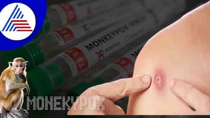 23 நாடுகளுக்கு பரவியுள்ள குரங்கு காய்ச்சல்..! உலக நாடுகளுக்கு  WHO எச்சரிக்கை