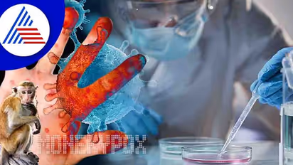 ಮಂಕಿಪಾಕ್ಸ್ v/s ಚಿಕನ್ ಪಾಕ್ಸ್: ಎರಡೂ ಸೋಂಕಿನ ಮಧ್ಯೆ ವ್ಯತ್ಯಾಸ ತಿಳಿದುಕೊಳ್ಳುವುದು ಹೇಗೆ ?