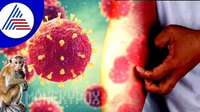 ಜಗತ್ತಿನಾದ್ಯಂತ ಹಬ್ಬುತ್ತಿದೆ ಮಹಾಮಾರಿ ಮಂಕಿಪಾಕ್ಸ್, ಭಾರತವೂ ಆತಂಕ ಪಡುವ ಅಗತ್ಯವಿದ್ಯಾ ?