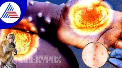 ಮಂಕಿಪಾಕ್ಸ್ ಸೋಂಕಿನ ಬಗ್ಗೆ ನೀವಂದುಕೊಂಡಿರೋ ಈ ವಿಚಾರವೆಲ್ಲಾ ನಿಜವಲ್ಲ !