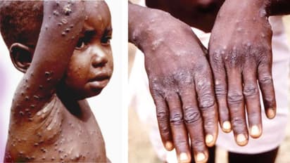 Monkeypox : കുരങ്ങുപനി; ഇന്ത്യയിലും ജാഗ്രത, മാർഗനിർദേശം ഉടനെന്ന് ആരോഗ്യ മന്ത്രാലയം