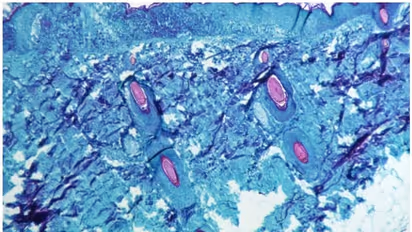 Monkeypox : മങ്കിപോക്സ് ലൈംഗിക ബന്ധത്തിലൂടെയാണോ പകരുന്നത്? ലോകാരോഗ്യ സംഘടന പറയുന്നത്