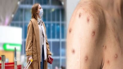 मंकीपॉक्स का बढ़ रहा है खतरा, विदेश में यात्रा करने से भले ध्यान रखें ये जरूरी बातें