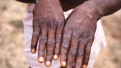 Monkeypox Disease : മങ്കിപോക്സ്; ഫ്രാന്‍സില്‍ മാത്രം 51 കേസുകള്‍, ആകെ 700 കേസുകള്‍