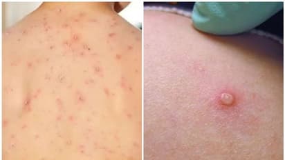 Monkeypox : മങ്കിപോക്സ് ; അവഗണിക്കരുത്, കുട്ടികളിൽ കാണുന്ന പ്രാരംഭ ലക്ഷണങ്ങൾ