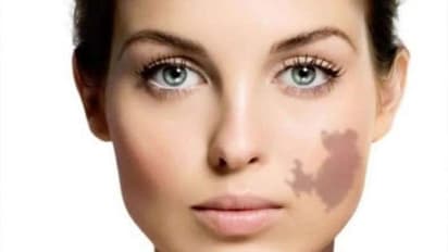 শরীরে এমন দাগ থাকা মানুষদের ভাগ্যবান মনে করা হয়, জেনে নিন কি বলছে সমুদ্র শাস্ত্র