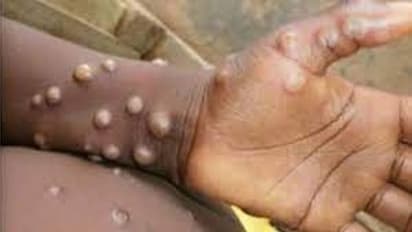 India's first Monkeypox case confirmed, Centre steps up surveillance; know about all about virus