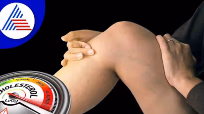 ಕಾಲಲ್ಲೂ ಕಾಣಿಸಿಕೊಳ್ಳುತ್ತೆ ಕೊಲೆಸ್ಟ್ರಾಲ್ ಸೂಚನೆ, ರೋಗಲಕ್ಷಣಗಳ ಬಗ್ಗೆ ಗೊತ್ತಿರಲಿ