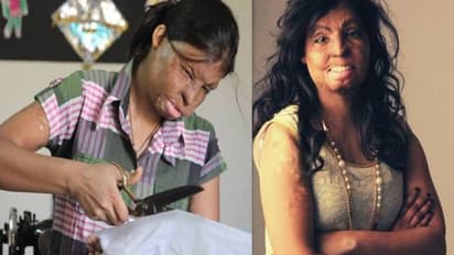 രണ്ടാനമ്മയുടെ കൊടുംക്രൂരത, മുഖത്ത് ആസിഡൊഴിച്ചു, കനൽവഴികൾ താണ്ടി രൂപ, ഇന്ന് ഡിസൈനർ 