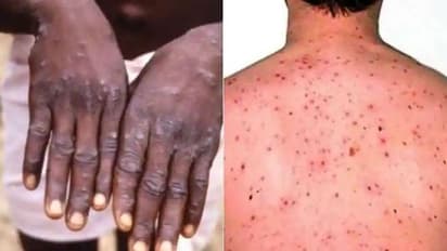 Monkeypox: WHO releases five critical measures to prevent the spread of infection