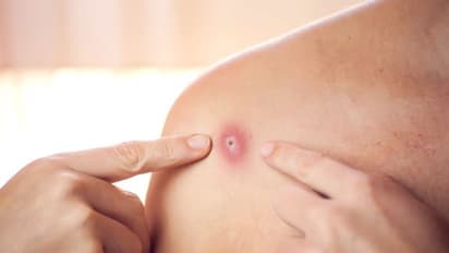 Monkeypox :  മങ്കിപോക്സ് കേസുകൾ ഒരാഴ്‌ചയ്‌ക്കുള്ളിൽ 77 ശതമാനം വർദ്ധിച്ചു : ലോകാരോഗ്യ സംഘടന