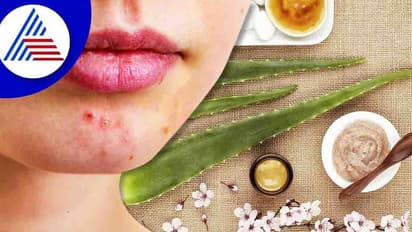 ಮೊಡವೆ ಕಲೆ ತೆಗೆಯೊಂದು ಇಷ್ಟೊಂದು ಸುಲಭಾನ ? ನೀವೂ ಟ್ರೈ ಮಾಡಿ