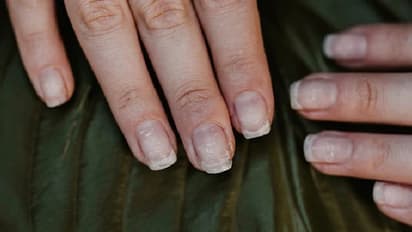 നഖങ്ങള്‍ ഇങ്ങനെയാകുന്നോ? കാരണം അറിയാം...