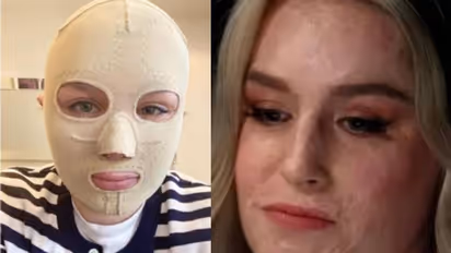 അഗ്നിപർവ്വത സ്‌ഫോടനത്തിൽ ഗുരുതരമായി പൊള്ളലേറ്റു, മാസ്ക് മാറ്റി ലോകത്തിന് മുന്നിൽ മുഖം വെളിപ്പെടുത്തി യുവതി