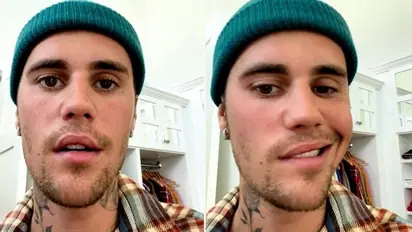 Justin Bieber diagnosed with Ramsay Hunt Syndrome; here’s everything about the facial paralysis