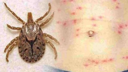 Scrub Typhus : ചെള്ള് പനി ബാധിച്ച് രണ്ട് മരണം; അറിയാം ഇതിന്‍റെ ലക്ഷണങ്ങള്‍...