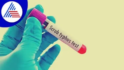 ಕೇರಳದಲ್ಲಿ 4 ದಿನದಲ್ಲಿ ಇಬ್ಬರ ಸಾವಿಗೆ ಕಾರಣವಾದ ಸ್ಕ್ರಬ್ ಟೈಫಸ್ ಕಾಯಿಲೆ ಎಂದರೇನು ? 