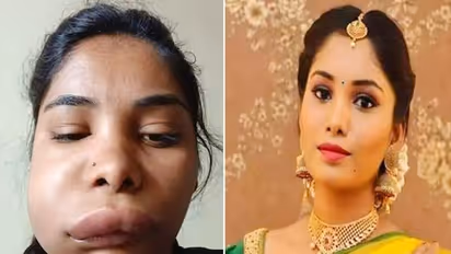 South actress Swathi Sathish looks unrecognisable after root canal surgery goes wrong
