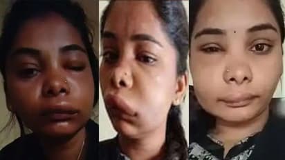 सर्जरी के बाद ऐसा बिगड़ा एक्ट्रेस का चेहरा कि पहचानना हुआ मुश्किल, अब घर से बाहर भी नहीं निकल रही