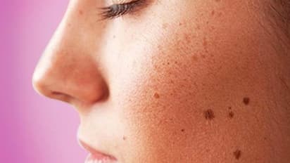 నల్లమచ్చలను తగ్గించి ముఖాన్ని కాంతివంతంగా మార్చే సూపర్ టిప్స్..!