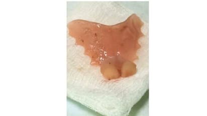 ഉറക്കത്തിൽ വെപ്പുപല്ല് തൊണ്ടയിലിറങ്ങി അന്നനാളത്തിൽ കുടുങ്ങി; ഒടുവിൽ എന്ഡോസ്കോപ്പിയിലൂടെ പുറത്തെടുത്തു