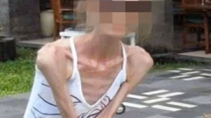 स्लिम होने को लड़की ने अपनाए अजब तरीके, सालभर में 65 से 25 किलो हुआ वजन, उसके बाद जानिए क्या हुआ उसके साथ