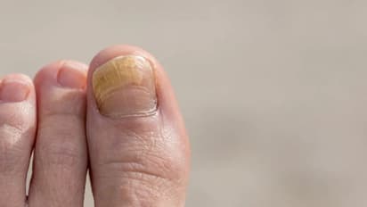 Nail Discoloration : കാല്‍നഖങ്ങള്‍ പൊട്ടുന്നതും നിറം മാറുന്നതും എന്തുകൊണ്ട്? 