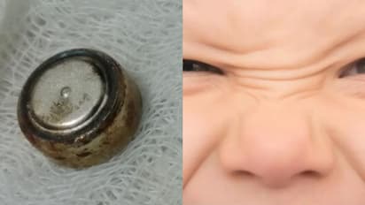 കളിക്കിടെ നാല് വയസുകാരൻ മൂക്കിൽ ബാറ്ററിയിട്ടു, ശ്വാസനാളത്തിൽ കുടുങ്ങി: വിദഗ്ധമായി പുറത്തെടുത്തു