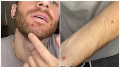 Monkeypox : പനിയും വിറയലും, ഉറക്കം നഷ്ടപ്പെട്ടു; മങ്കിപോക്സിനെ തമാശയായി കാണരുതെന്ന് അമേരിക്കൻ നടൻ