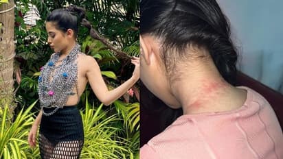 ചങ്ങല കൊണ്ടുള്ള ടോപ് ധരിച്ച് ഫോട്ടോഷൂട്ട്; കഴുത്തിന് പരുക്കേറ്റ ചിത്രം പങ്കുവച്ച് ബിഗ് ബോസ് താരം