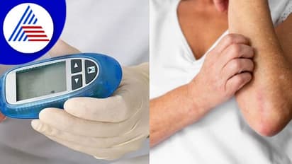 ಡಯಾಬಿಟಿಸ್ ಇರೋರು ಚರ್ಮದ ಬಗ್ಗೆಯೂ ಕಾಳಜಿ ವಹಿಸಿ