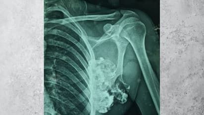 जयपुर के डॉक्टरों ने किया कमाल, कंधे की हड्डी से फूलगोभी की साइज का ट्यूमर निकाला...रिपोर्ट देख रह गए थे दंग