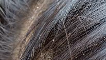 తలలో పేలు వేధిస్తున్నాయా.. వాటి బాధ తగ్గాలంటే ఈ పద్ధతులు పాటించండి!