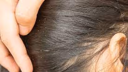 தலையில் பொடுகு, முடி உதிர்வு தொல்லையா? முற்றிலும் விடுபட இந்த ஒரு பொருளை தேங்காய் எண்ணெயுடன் சேர்த்தால் போதும்