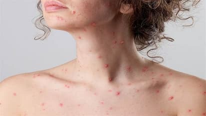  அய்யோ ஆண்டவா.. இந்தியாவிலும் நுழைந்தது குரங்கு காய்ச்சல்.. அதிர்ச்சியில் மருத்துவர்கள்.  