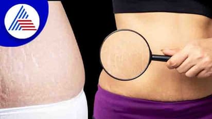 ಸ್ಟ್ರೆಚ್ ಮಾರ್ಕ್ ಬಗ್ಗೆ ಚಿಂತೆ ಬೇಡ, ಈ ಮನೆಮದ್ದು ಟ್ರೈ ಮಾಡಿ...