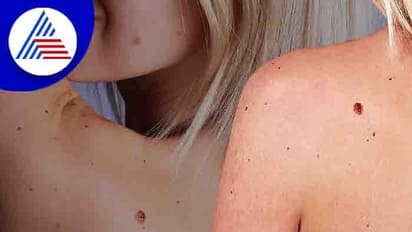 Skin Cancer: ನಿಮ್ಮ ದೇಹದ ಮೇಲೂ ಇಂತಹ ಮಚ್ಚೆಗಳಿವೆಯೇ? ಎಚ್ಚರವಿರಲಿ